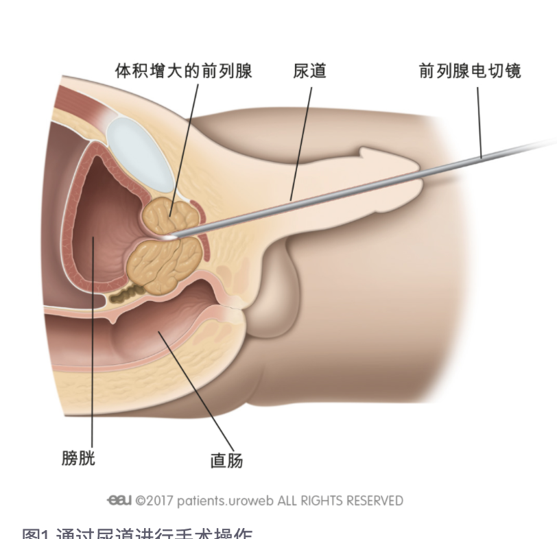 最新前列腺手术技术革新，为病患带来福音