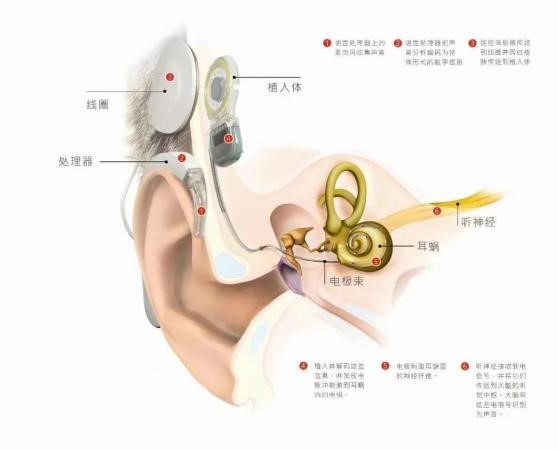 人工耳蜗最新技术，重塑听力的希望之光，开启无声世界的全新篇章